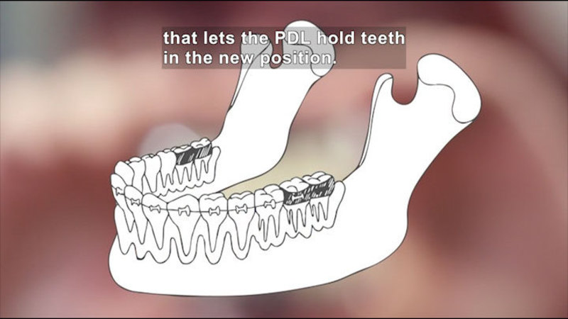 Illustration of teeth in the bottom jaw with braces on the surface of the teeth. The two teeth on either end of the jaw are shaded darker. Caption: that lets the new PDL hold teeth in the new position.