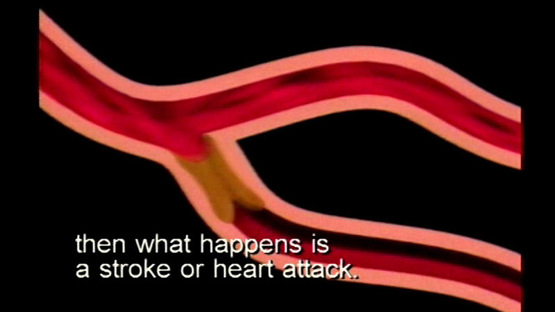 Illustration of a vein blocked by a fatty substance. Caption: then what happens in a stroke or heart attack.