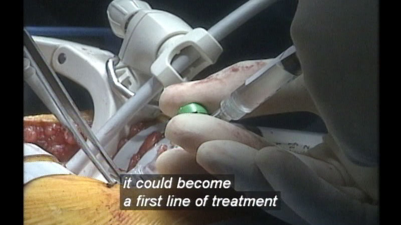 Hands involved in a surgical procedure holding a syringe while other instruments work in an open body. Caption: it could become a first line of treatment