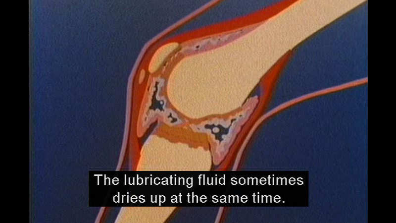 Diagram of the human knee showing bone, tendons and ligaments, and cushioning tissues. Caption: The lubricating fluid sometimes dries up at the same time.