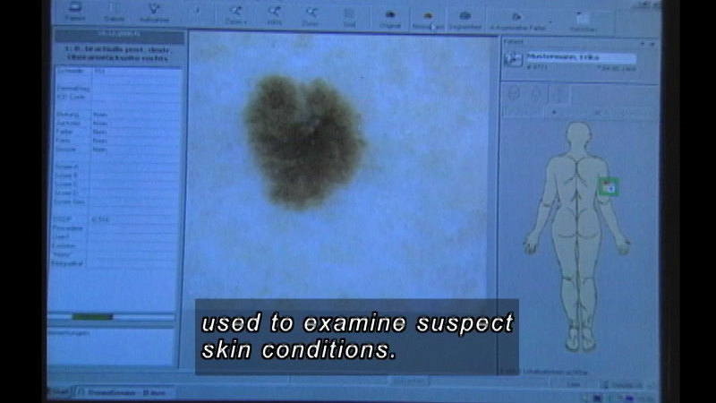 Computer screen with a closeup image of an area of a person's body. Corresponding area is outlined on a diagram of the body. Caption: used to examine suspect skin conditions.