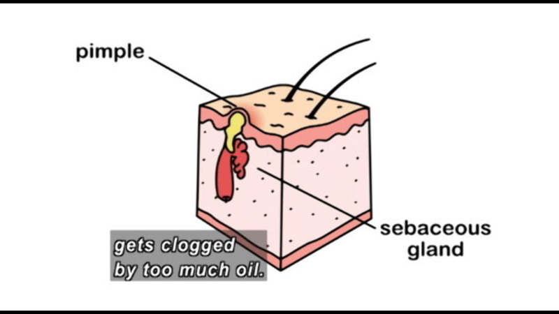 Illustration of skin showing the sebaceous gland and a pimple. Caption: gets clogged by too much oil. 