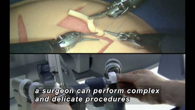 Split image of mechanical clasps and pinchers stitching an incision and human hands manipulating mechanical controls. Caption: a surgeon can perform complex and delicate procedures