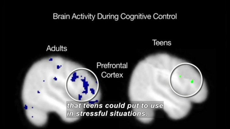 Brain activity during cognitive control. Prefrontal cortex of an adult shows significantly more activity in multiple areas as compared to a teen. Caption: that teens could put to use in stressful situations.
